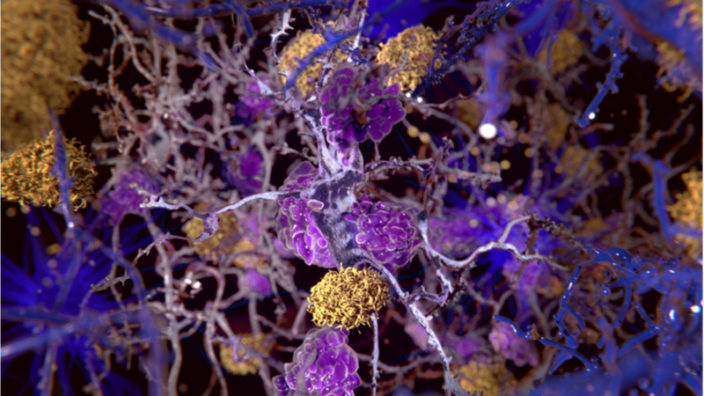 Glia Alzheimer's