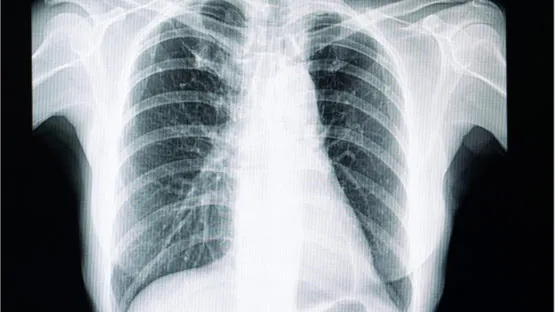 X-ray of fibrosis