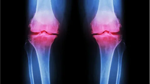 Image of knee inflammation caused by osteoarthritis