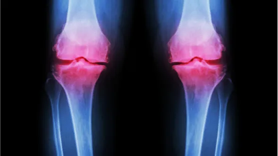 Image of knee inflammation caused by osteoarthritis