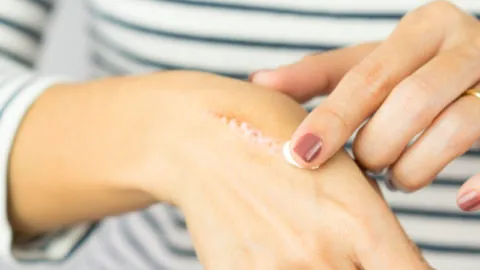 Woman applying topical skin cream