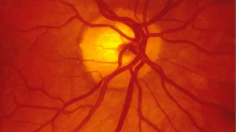 the retina