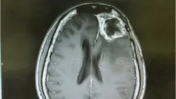 Glioblastoma