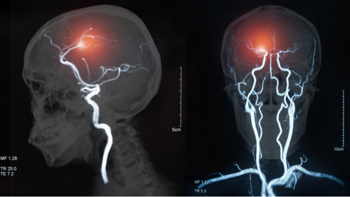 Blood vessels in the brain