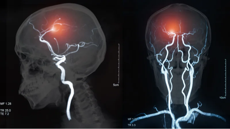 Blood vessels in the brain