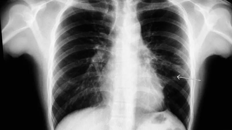 Chest fibrosis