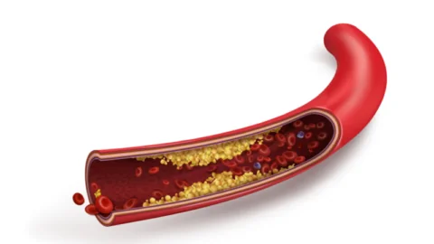 Atherosclerosis