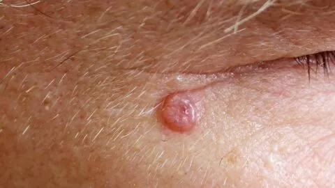 Basal cell carcinoma