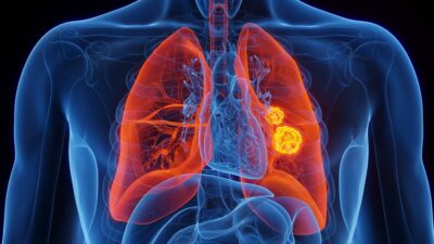 Lung cancer