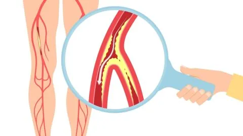 Peripheral artery disease