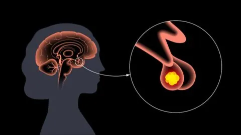 Pituitary tumor