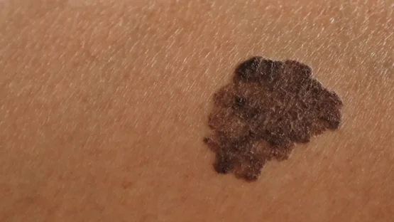 Skin cancer