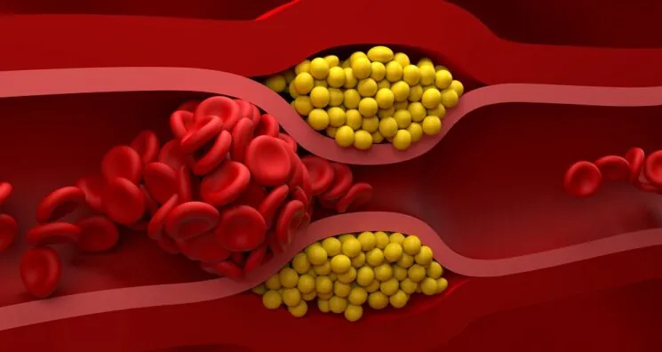 Cyclarity Launches Human Trial for Atherosclerosis