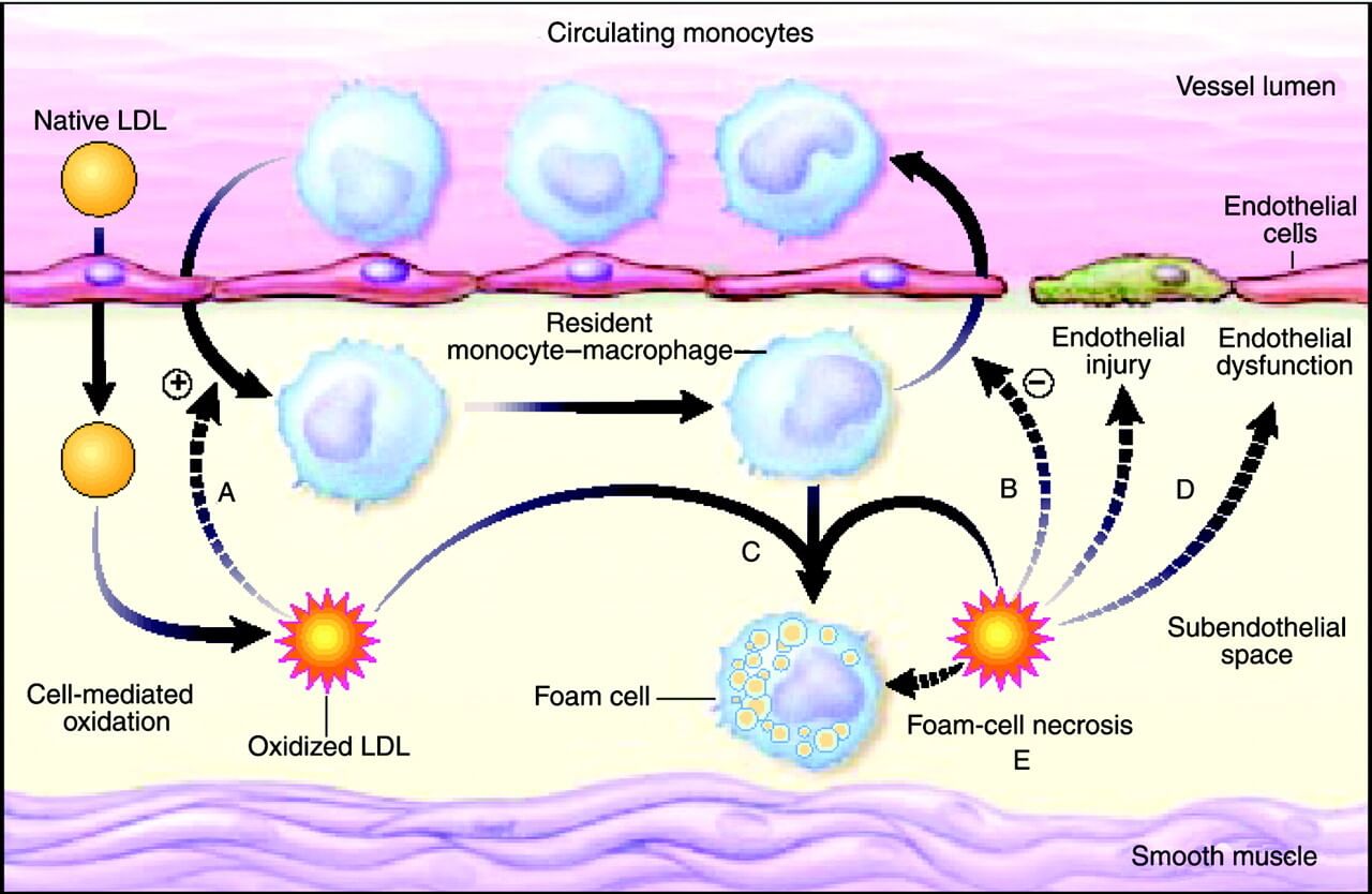 Macrophages gorge on oxidized LDL cholesterol, which converts them to foam cells and initiates and exacerbates atherosclerotic plaque.