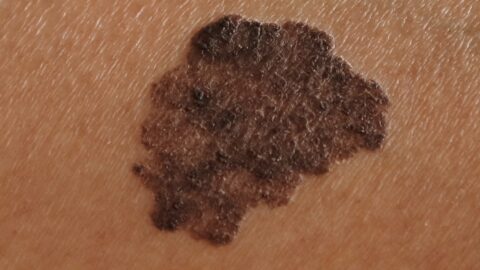 Melanoma