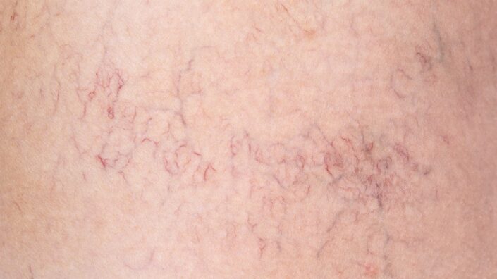 Skin capillaries