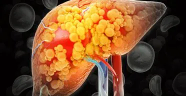 Study Uncovers How Obesity Drives Chronic Inflammation