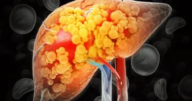 Study Uncovers How Obesity Drives Chronic Inflammation