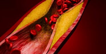 The Many Dangers of 7-Ketocholesterol