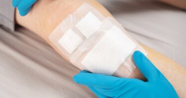 A Robust Senescence Response Helps Wounds Heal