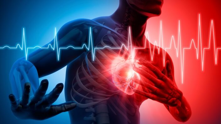 Heart attack
