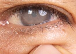 How an Oxidative Stress Regulator Makes Cataracts Worse