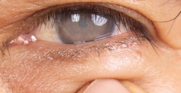 How an Oxidative Stress Regulator Makes Cataracts Worse