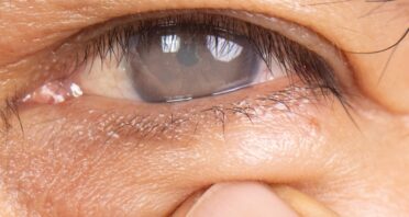 How an Oxidative Stress Regulator Makes Cataracts Worse