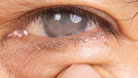 Cataracts