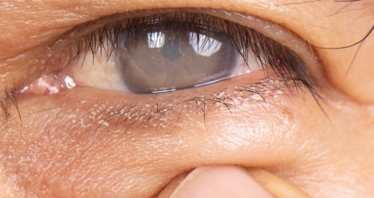 How an Oxidative Stress Regulator Makes Cataracts Worse