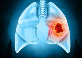 Early Cancer Cells Change Their Surroundings to Form Tumors