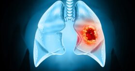 Early Cancer Cells Change Their Surroundings to Form Tumors