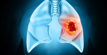 Early Cancer Cells Change Their Surroundings to Form Tumors