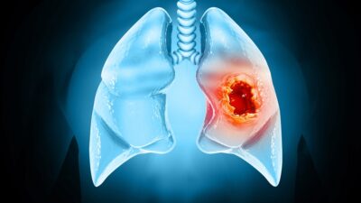 Lung cancer tumor