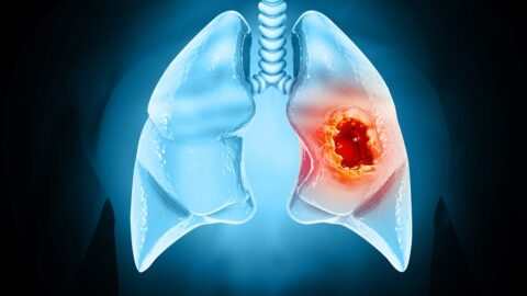 Lung cancer tumor