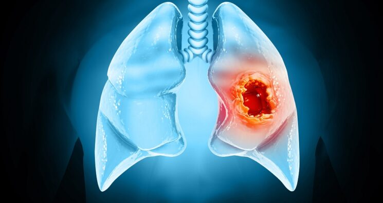 Early Cancer Cells Change Their Surroundings to Form Tumors