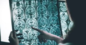 Glycosylation’s Role in Alzheimer’s Disease
