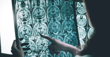 Glycosylation’s Role in Alzheimer’s Disease