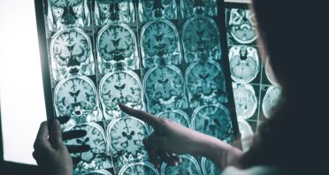 Glycosylation’s Role in Alzheimer’s Disease