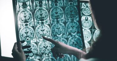 Glycosylation’s Role in Alzheimer’s Disease