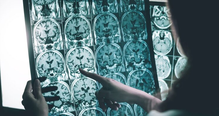 Glycosylation’s Role in Alzheimer’s Disease