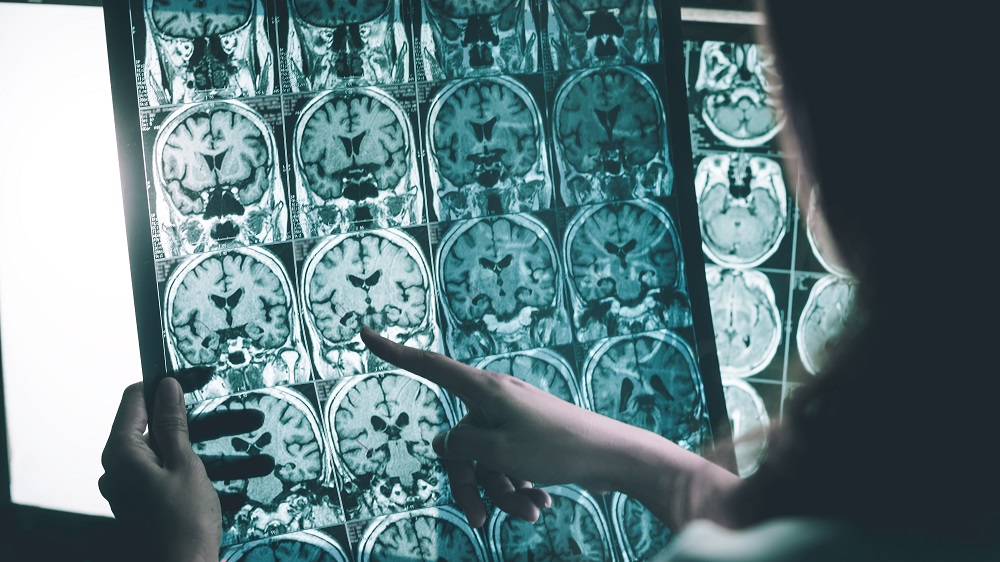 Alzheimer's MRI