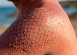 How the Immune System Makes Sun Damage Worse