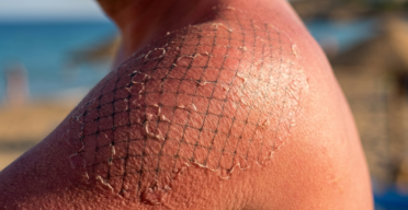 How the Immune System Makes Sun Damage Worse