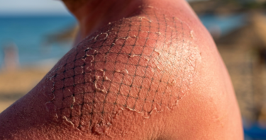 How the Immune System Makes Sun Damage Worse