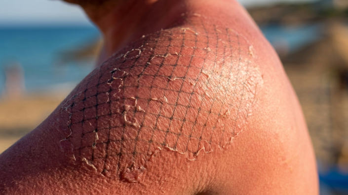 How the immune system makes sun damage worse, explained