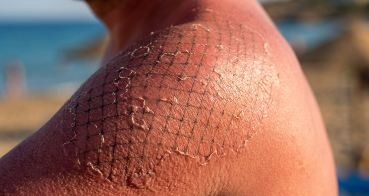 How the Immune System Makes Sun Damage Worse