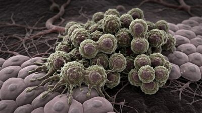 Aggressive cancer