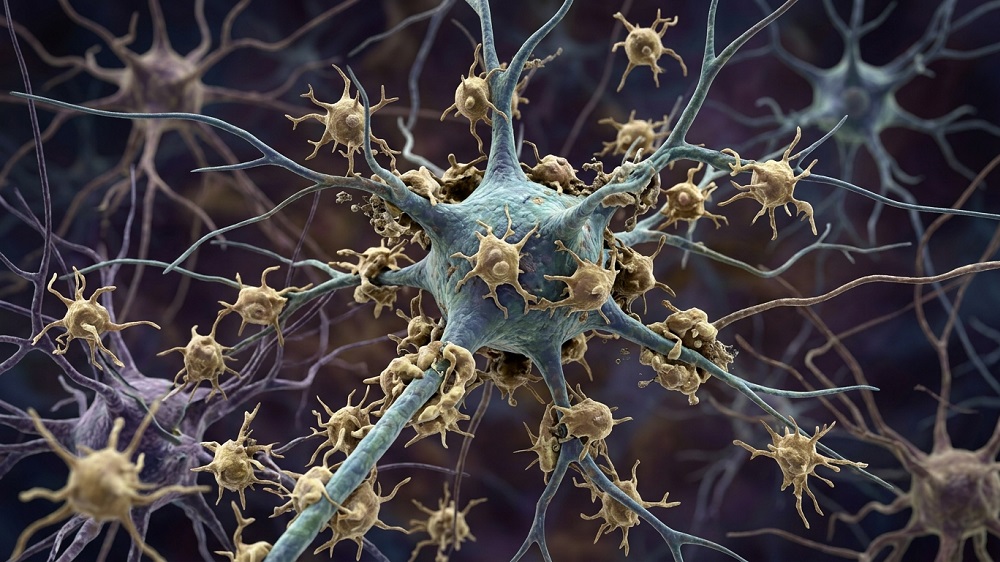 Microglia attacking a neuron
