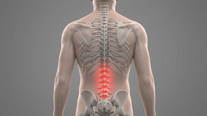 Inflamed lower back discs